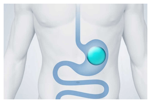 Balão Intragástrico em Goiânia